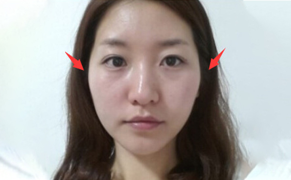 蘭州亞韓整形：顴骨突出做顴骨降低整形手術(shù)就對了