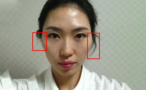 顴骨整形一般需要多少錢?受哪些因素影響?