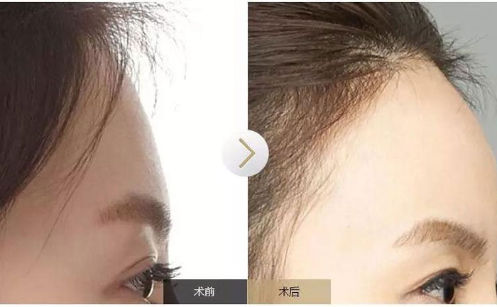 額頭填充術(shù)可以保持多久？