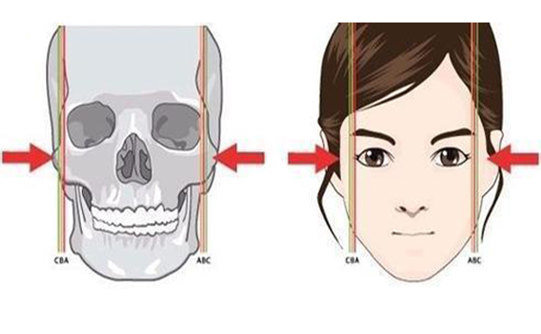 重慶五洲顴骨整形手術是怎么做的?具體有哪些步驟?