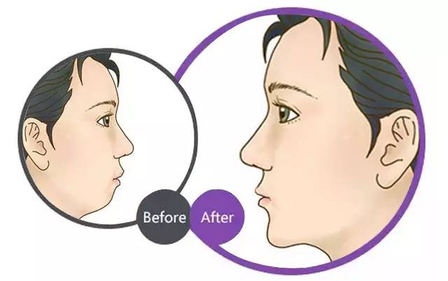 下巴突出是什么原因引起的？