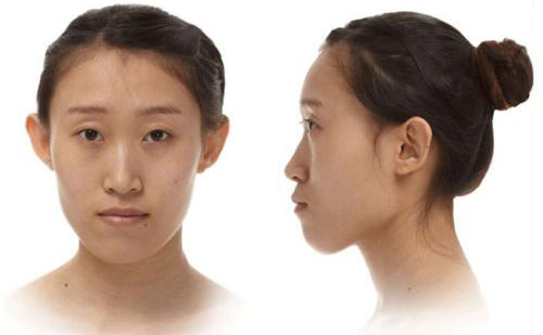 下巴突出是什么原因引起的？下巴突出側(cè)面很難看怎么矯正？