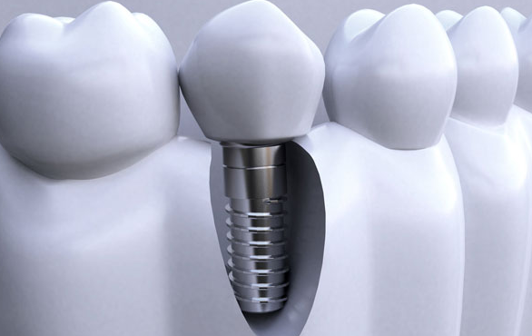 種植牙能使用多少年？