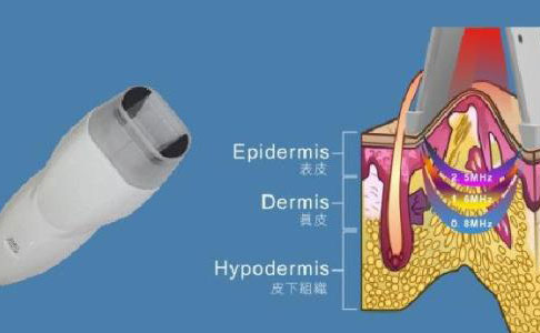 射頻除皺的效果好嗎？