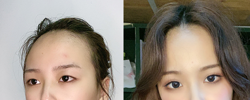 蘭州亞韓做雙眼皮案例對比圖