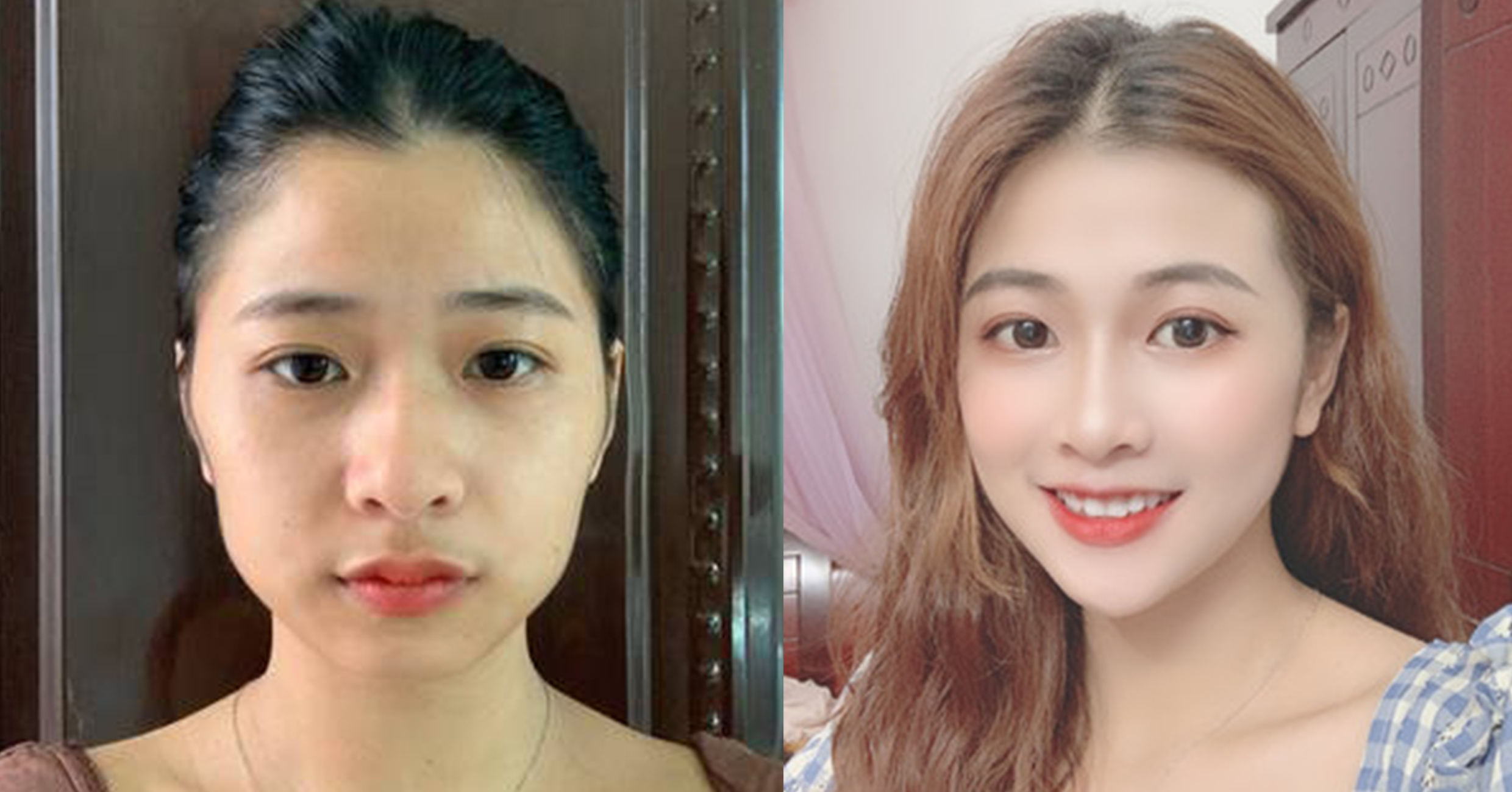 脂肪填充手術(shù)效果對(duì)比