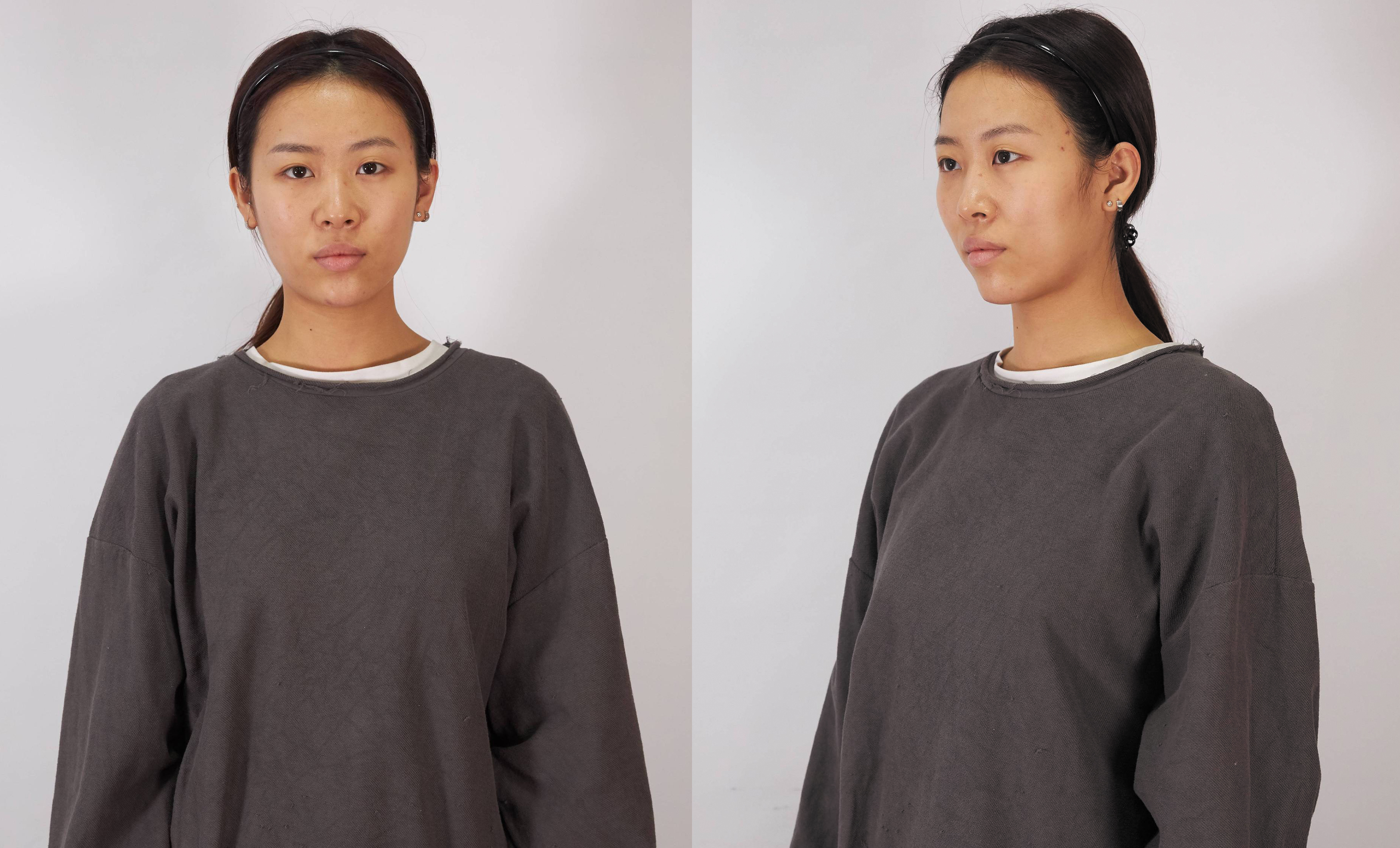 寧波藝星熱瑪吉術(shù)后一年效果反饋1