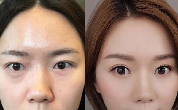 做去眼袋的手術(shù)會(huì)不會(huì)反彈?有副作用嗎?