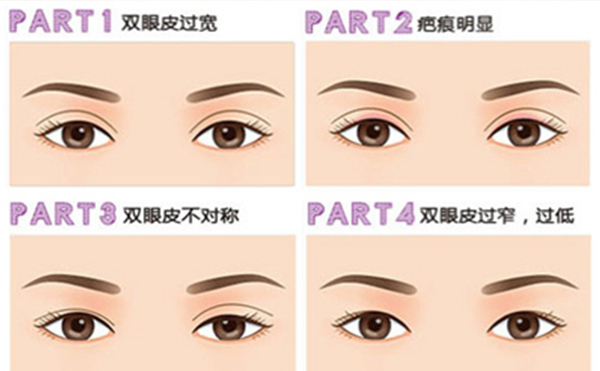 雙眼皮手術(shù)失敗如何修復呢?需要多長時間?