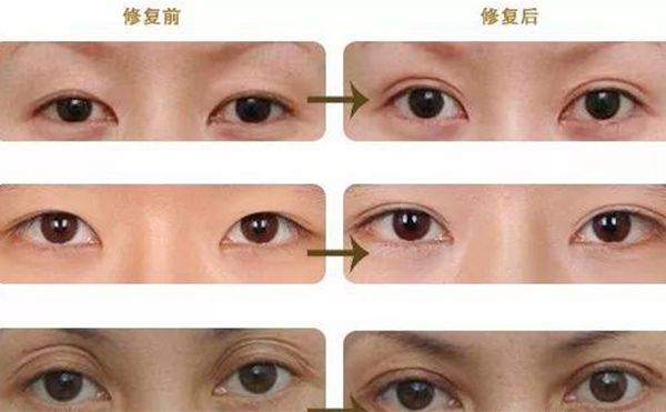 雙眼皮修復(fù)可靠嗎？什么時(shí)候做雙眼皮修復(fù)比較好？