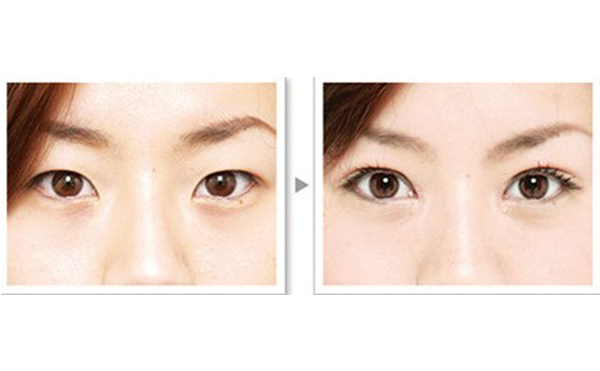 雙眼皮手術(shù)的種類及優(yōu)缺點(diǎn)是什么?術(shù)后怎么護(hù)理效果好?