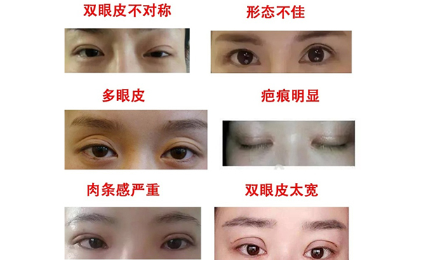 哪些情況需做雙眼皮修復(fù)？修復(fù)難度大不大?