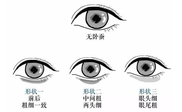 臥蠶有哪幾種形態(tài)?為什么有些人的臥蠶顯老?