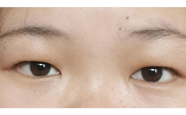 超聲波去腫眼泡效果怎樣?超聲波去腫眼泡多少錢(qián)?