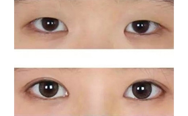 割雙眼皮能改善腫眼泡嗎?效果怎么樣?