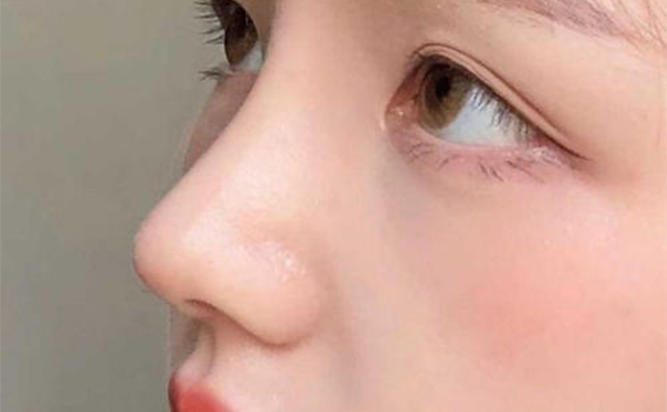 鼻假體取出術容易嗎?