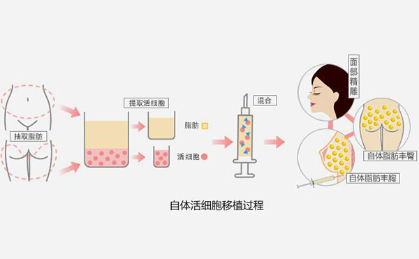 填充臀部有哪些方法?疤痕體質(zhì)可以做豐臀嗎?