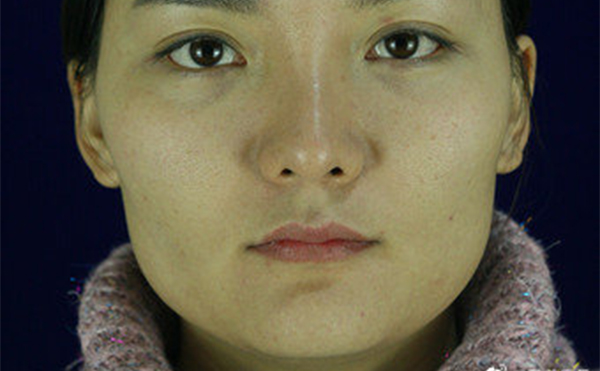 石家莊藍山杜建龍醫(yī)生下頜角整容手術案例術前效果