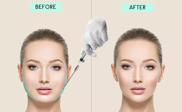 面部吸脂有哪幾種手術(shù)方法？