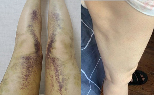 腹部吸脂有什么副作用？