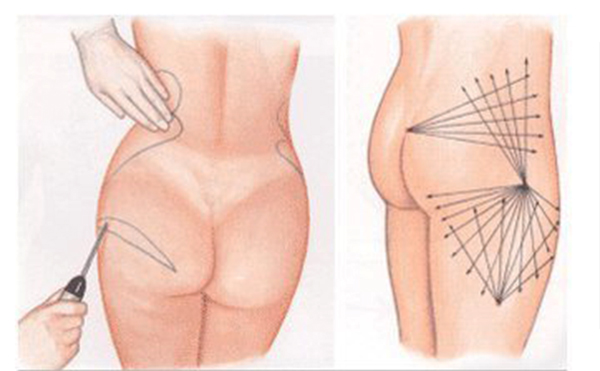 臀部吸脂的手術(shù)過程是什么？