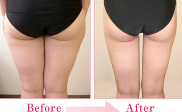 臀部抽脂有什么優(yōu)點？