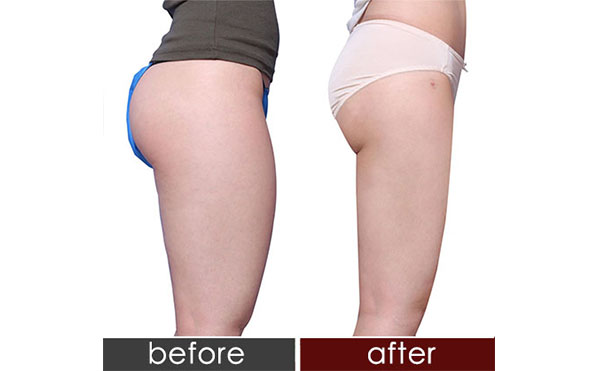 臀部抽脂會不會反彈?