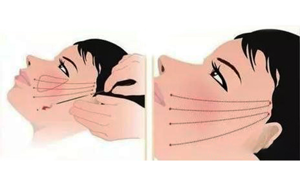 拉皮的原理是什么？