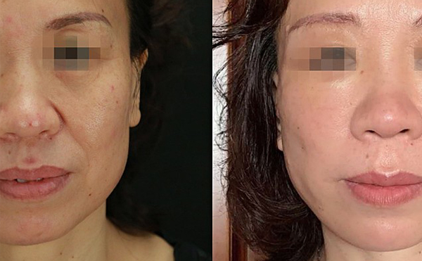 哪些人適合做拉皮手術(shù)？