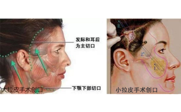 小拉皮和傳統(tǒng)拉皮有什么區(qū)別？