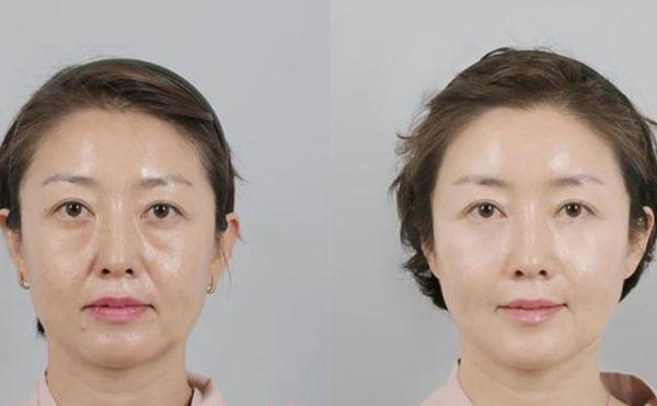 拉皮手術的過程是什么?術后需要注意什么?