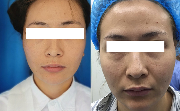 拉皮和線雕哪個(gè)效果好？