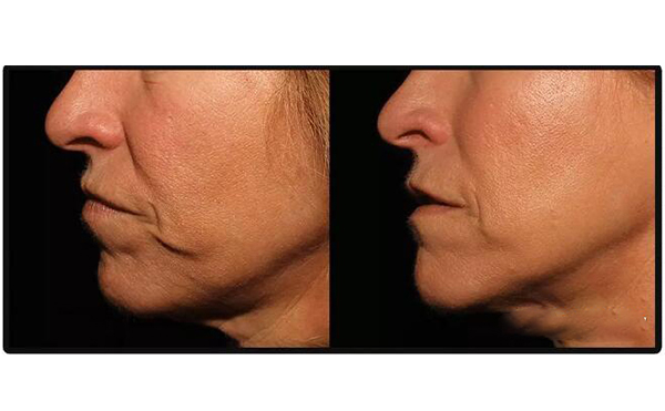 電波拉皮安全嗎？