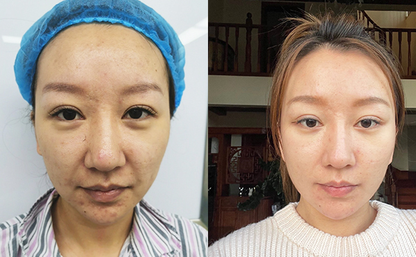 電波拉皮除皺效果能維持多久？