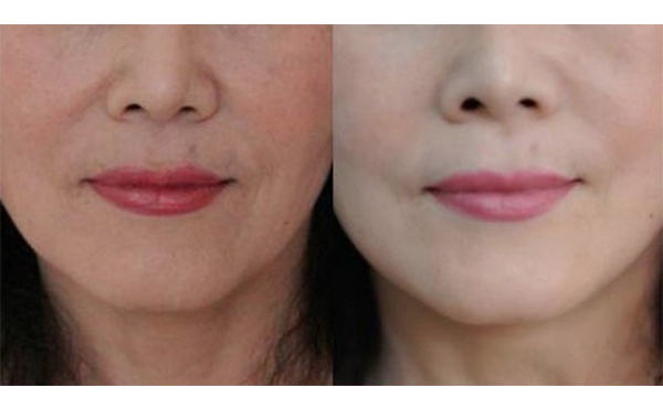 電波拉皮除皺后會腫脹嗎？