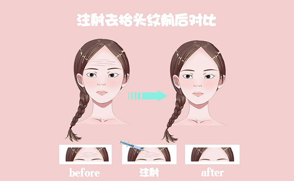 電波拉皮怎么去除抬頭紋？