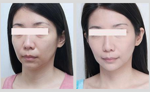 激光除皺是什么原理？