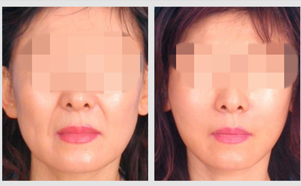 激光除皺需要做幾次才能出效果？