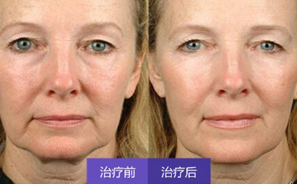 激光除皺有副作用嗎?術(shù)后怎么護理?