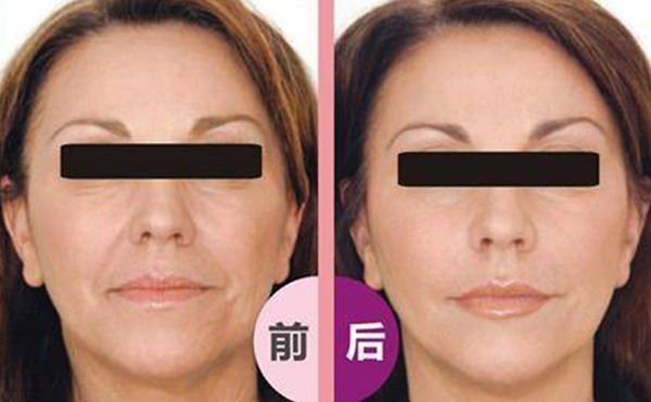 激光除皺會反彈嗎？