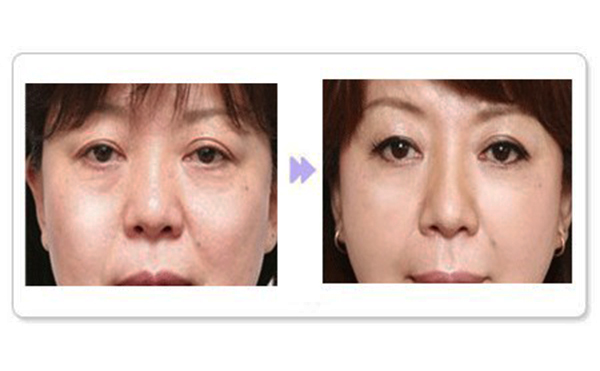 除皺針適合哪個年齡段？