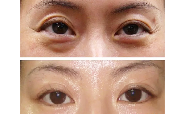 魚尾紋是怎么引起的？