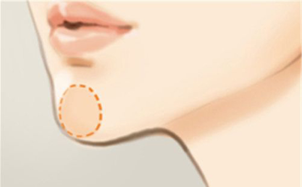 下巴整形恢復期要多久？