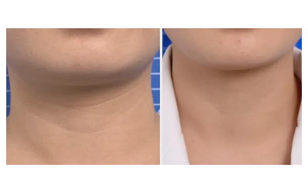 頸紋是怎么形成的？