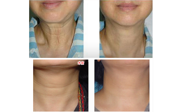 激光去除頸紋有什么優(yōu)勢？