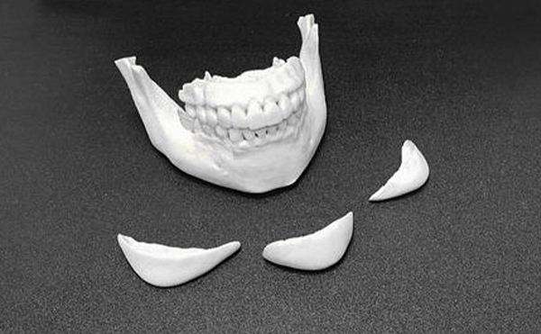 為什么做下巴整形的人越來越多?假體下巴取出后下巴還能恢復(fù)到術(shù)前的樣子嗎?