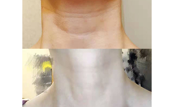 嗨體可以長(zhǎng)期使用嗎？