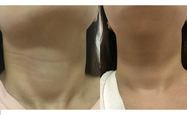 嗨體去頸紋會反彈嗎？