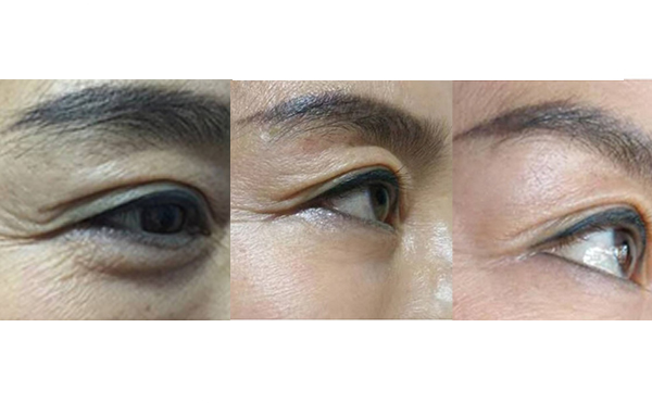 膠原蛋白除皺是什么原理？