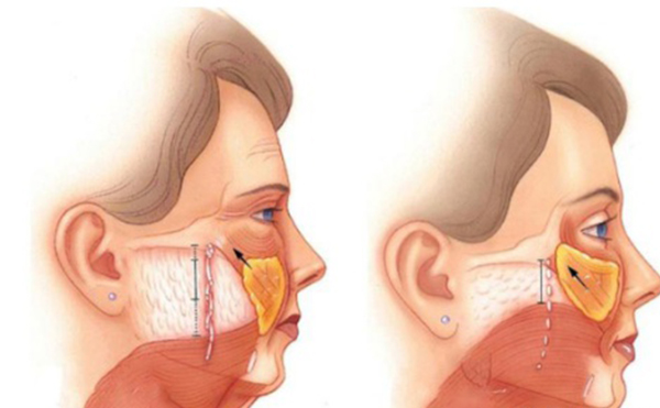 筋膜懸吊除皺是什么原理？